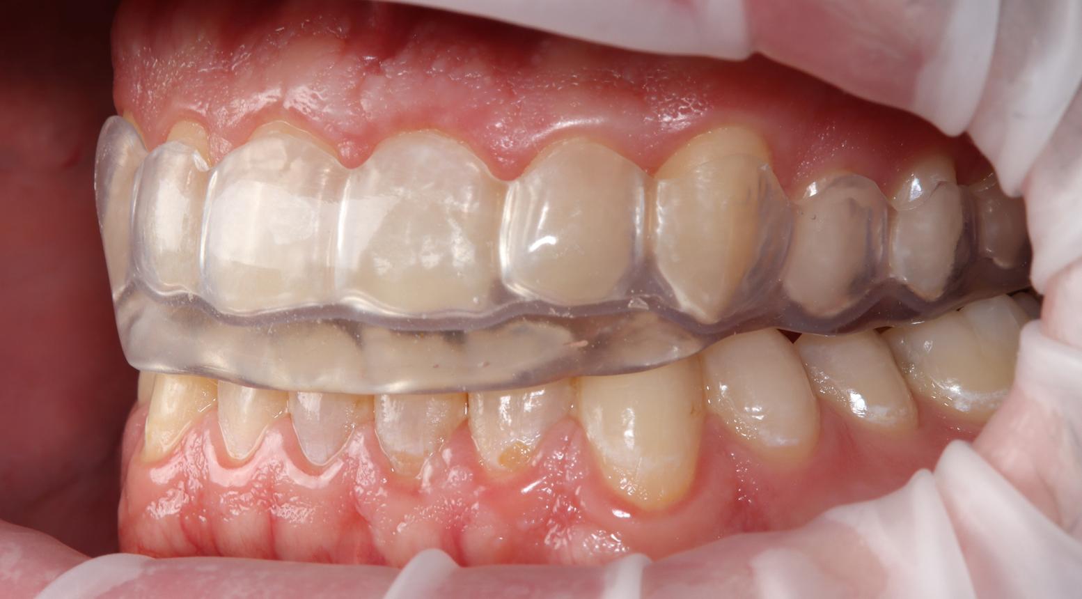 Placa oclusal transparente sobre superfície de consultório odontológico